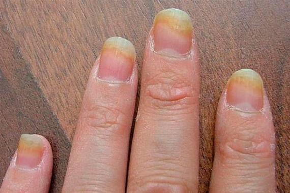 Что делать если слоятся ногти на руках?