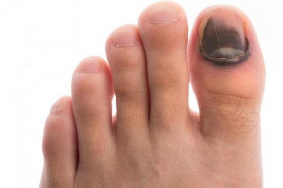 Cum să eliminați un hematom sub o unghie Un hematom de pe unghia de la picior nu dispare
